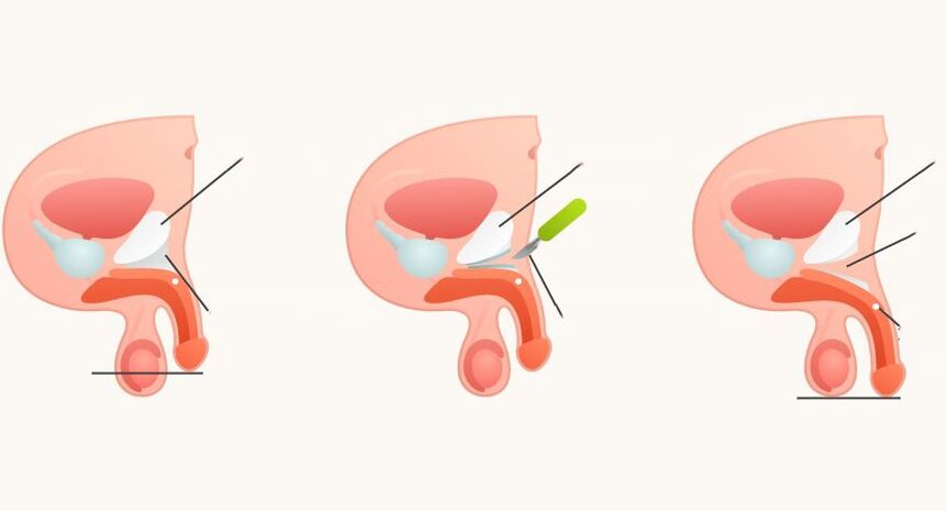 ligamentotomía para agrandamento do pene